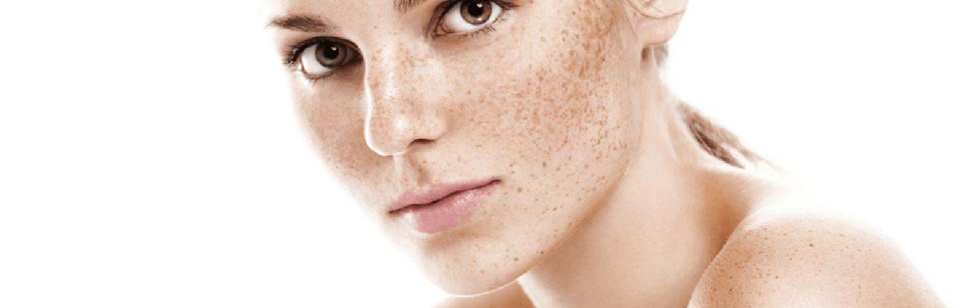 melasma