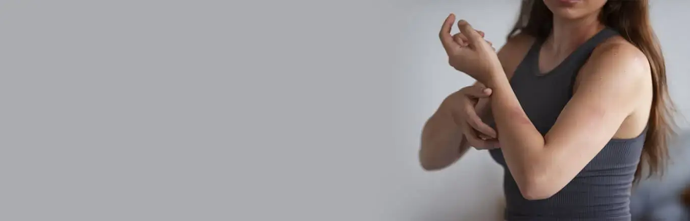 Beat the Heat! The Prickly Heat!