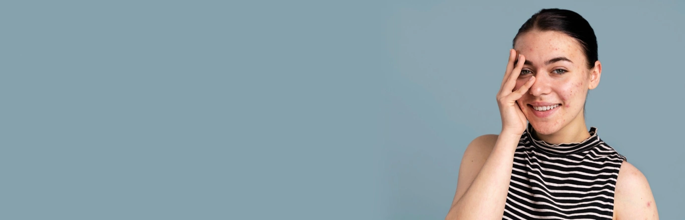 Acne: Causes and Effective Treatment Options