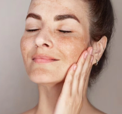 How to Identify Your Type of Pigmentation and Treat It Effectively