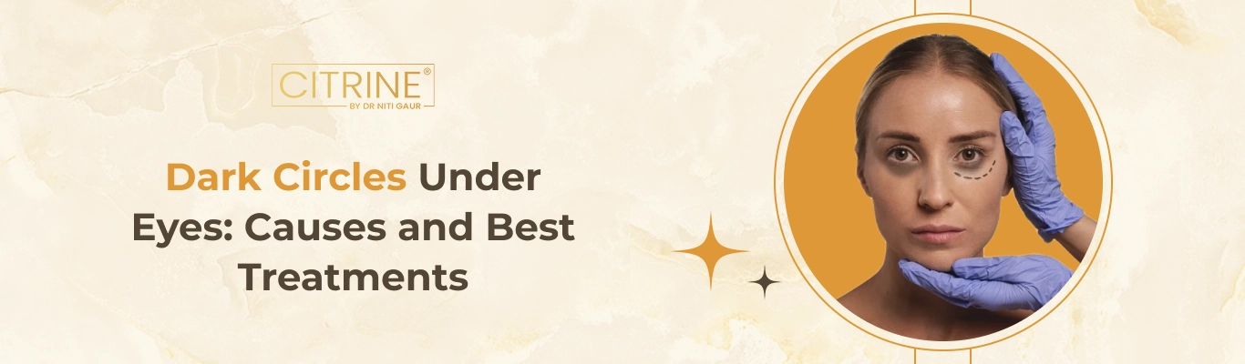 Dark Circles Under Eyes: Causes and Best Treatments