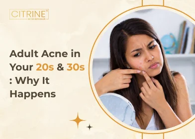 Adult Acne in Your 20s & 30s: Why It Happens