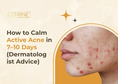 How to Calm Active Acne in 7–10 Days (Dermatologist Advice)