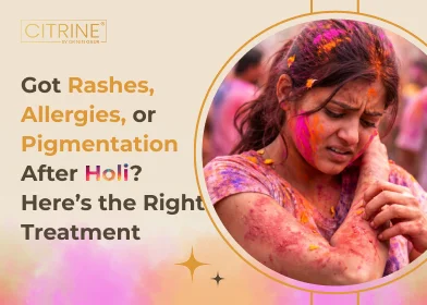 Got Rashes, Allergies, or Pigmentation After Holi? Here’s the Right Treatment