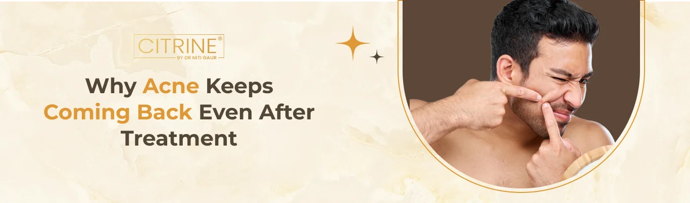 Why Acne Keeps Coming Back Even After Treatment?