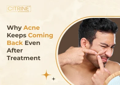 Why Acne Keeps Coming Back Even After Treatment?