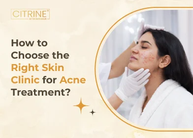 How to Choose the Right Skin Clinic for Acne Treatment?