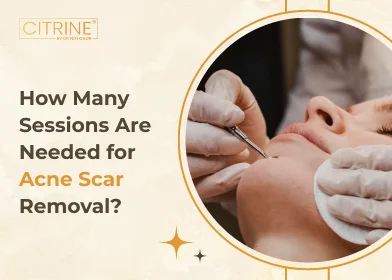 How Many Sessions Are Needed for Acne Scar Removal?