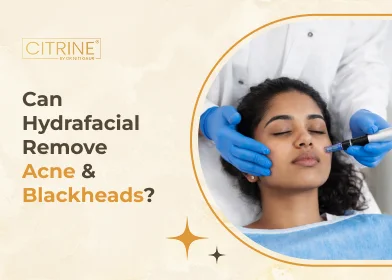 Can Hydrafacial Remove Acne & Blackheads?