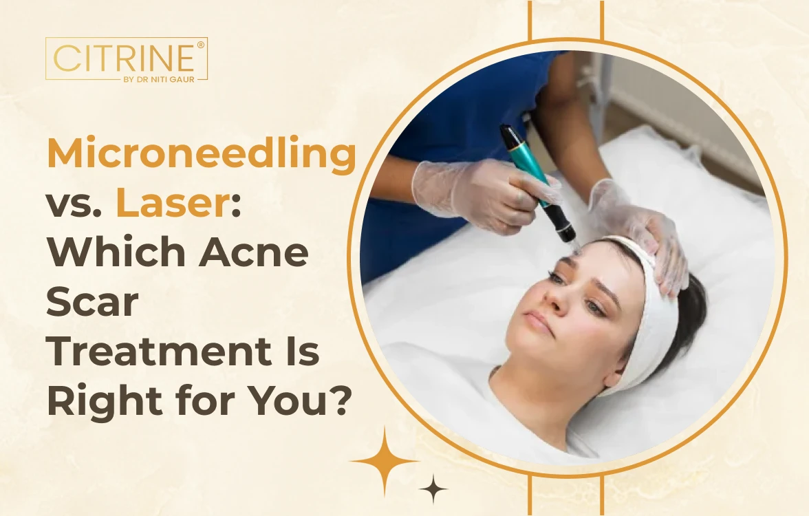 Microneedling vs. Laser: Which Acne Scar Treatment Is Right for You?
