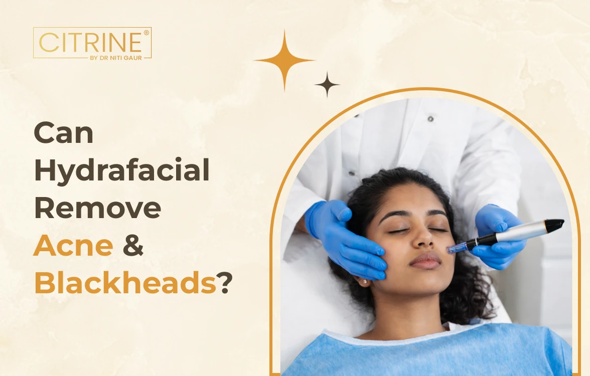 Can Hydrafacial Remove Acne & Blackheads?