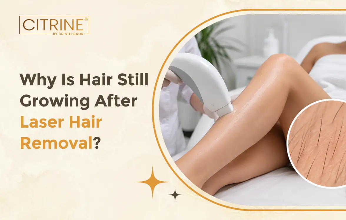 Why Is Hair Still Growing After Laser Hair Removal?