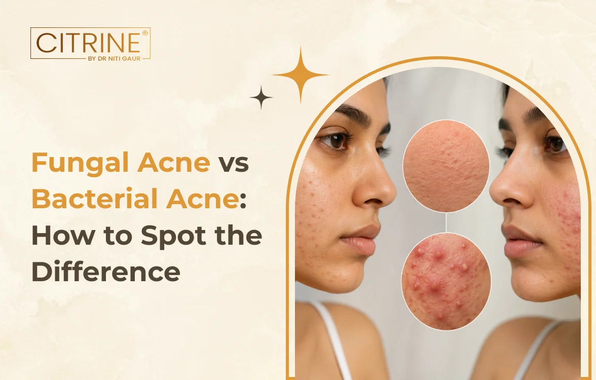 Fungal Acne vs Bacterial Acne: How to Spot the Difference