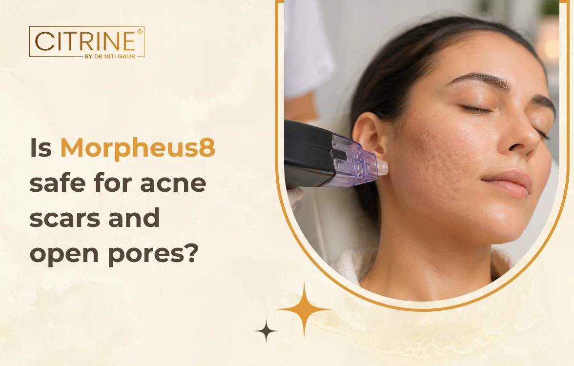 Is Morpheus8 Safe for Acne Scars and Open Pores?