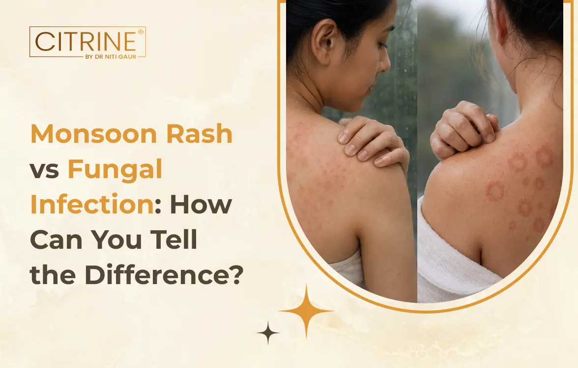 Monsoon Rash vs Fungal Infection: How Can You Tell the Difference