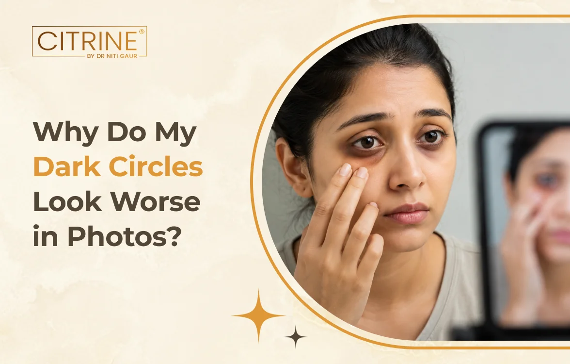 Why Do My Dark Circles Look Worse in Photos?