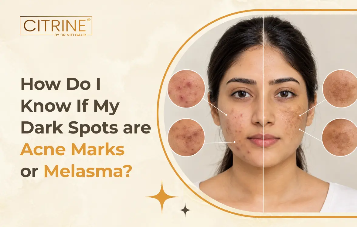 How Do I Know If My Dark Spots are Acne Marks or Melasma?