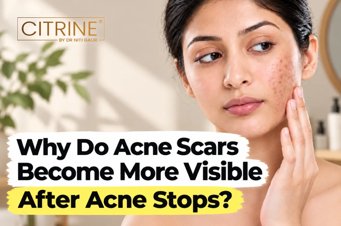 Why Do Acne Scars Become More Visible After Acne Stops?