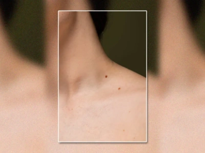 Are Your Moles Changing? When to Worry and How to Protect Your Skin.