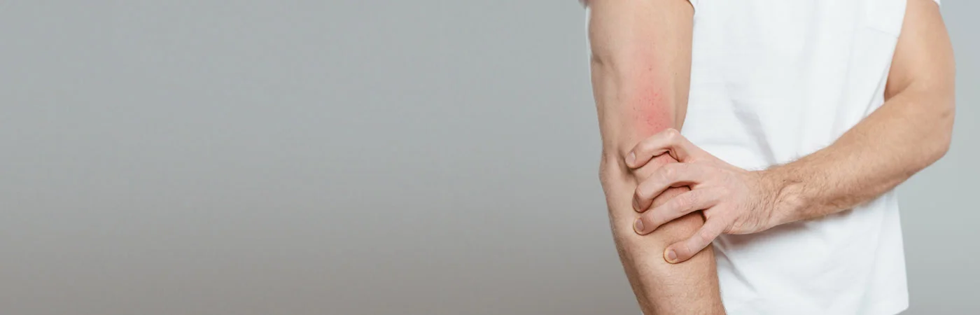 Eczema Treatment in Gurgaon