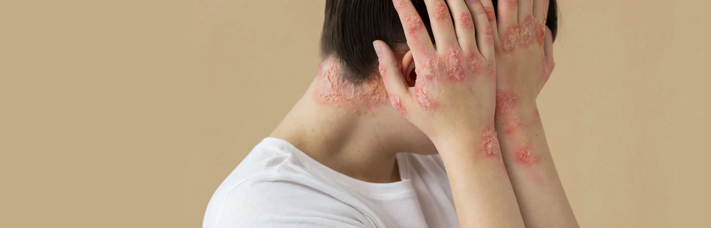 Psoriasis Treatment in Gurgaon