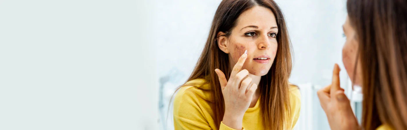 Acne Scar Treatment in Gurgaon