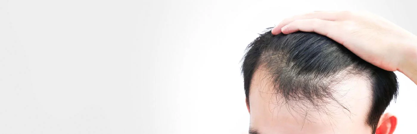 FUE Hair Transplant in Gurgaon