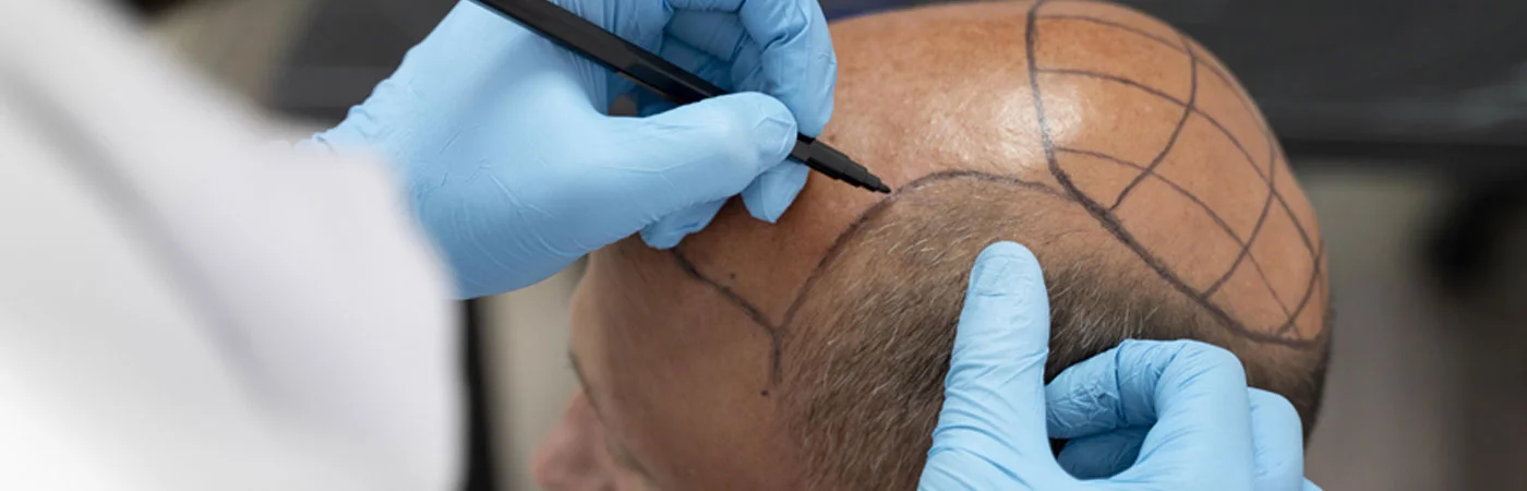 Best Hair Transplant Clinic in Gurgaon