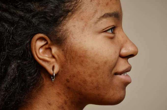 Uneven Skin Tone Treatment in Delhi