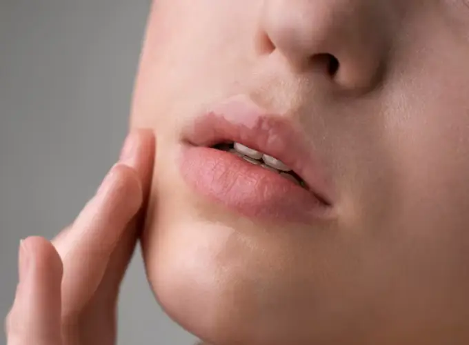 Dark Lips Treatment in Delhi