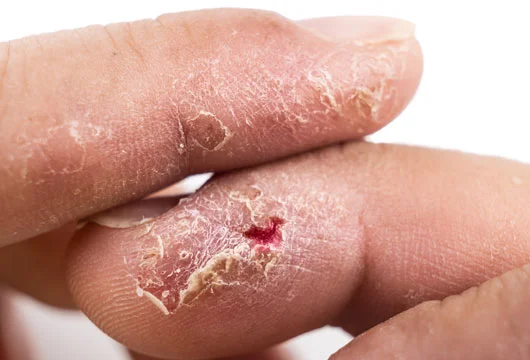 Fungal Infection Treatment in Gurgaon