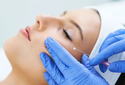 Thread lift Treatment in Gurgaon