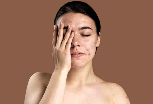 Dark Spots Removal Treatment in Gurgaon