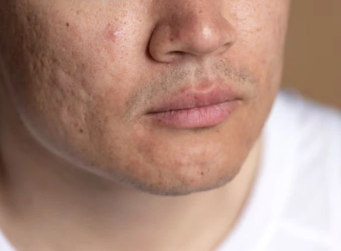 Acne Scar Treatment in Gurgaon
