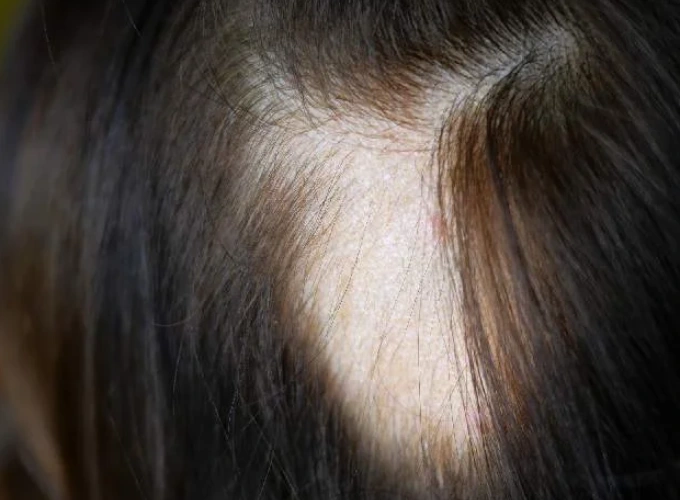 Androgenetic Alopecia ( Patterned hair loss and hair thinning)