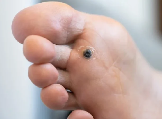 Warts and Corns Removal Treatment in Gurgaon
