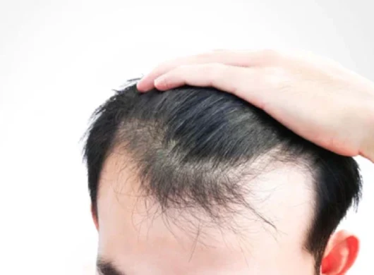 FUE Hair Transplant in Gurgaon