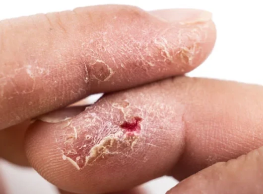 Fungal Infection Treatment in Gurgaon