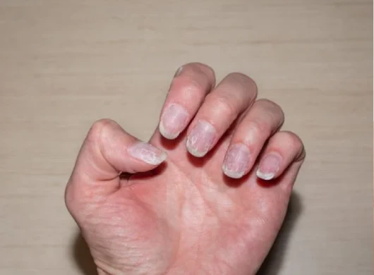 Fungal Nail Infection Treatment in Gurgaon