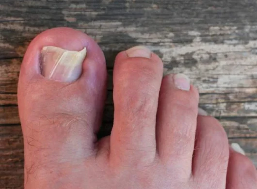 Ingrown Toenail Treatment in Gurgaon