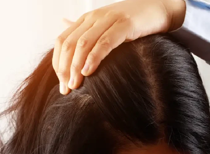 Oily Scalp Treatment in Gurgaon