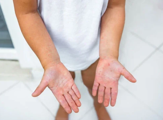 Psoriasis Treatment in Gurgaon
