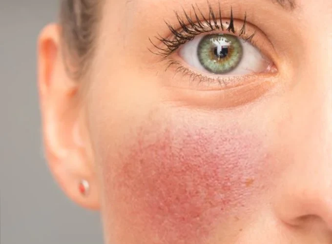 Rosacea Treatment in Gurgaon