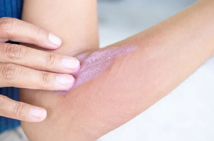 Urticaria Treatment in Gurgaon