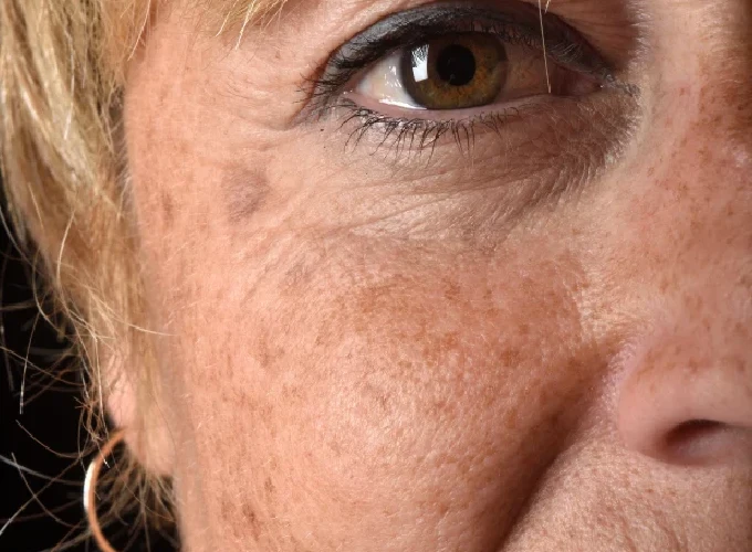 Age Spots and Pigmentation Treatment in Gurgaon