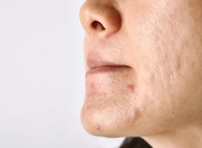 Rough Skin Texture Treatment in Gurgaon