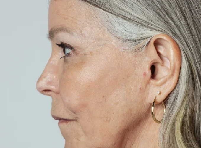 Ear Lobe Repair Treatment in Gurgaon