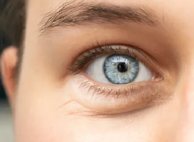 Under-Eye Puffiness Treatment in Gurgaon