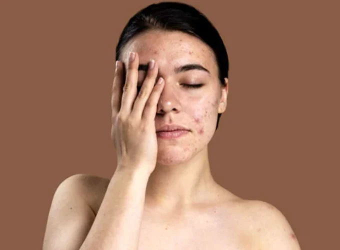 Dark Spots Treatment in Gurgaon