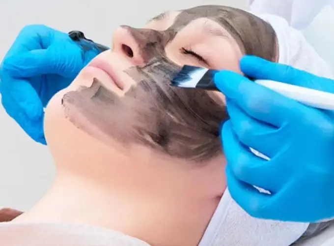 Carbon Peel Treatment in Delhi